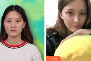 馬鞍山康視眼科醫(yī)院劉慶淮整形價(jià)格表附內(nèi)切祛眼袋案例展示