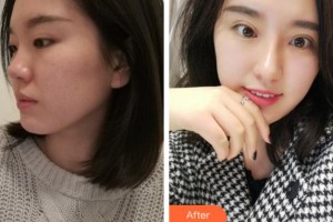 馬鞍山康視眼科醫(yī)院李一壯整形價(jià)格表附眼部整形案例展示