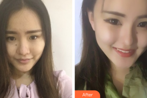 廣州現(xiàn)代醫(yī)院數(shù)字化整形美容中心謝大明整形價(jià)格表附鼻部手術(shù)案例展示