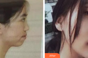 廣州中科美整形醫(yī)院陳昌華整形價(jià)格表附金屬托槽矯正案例展示