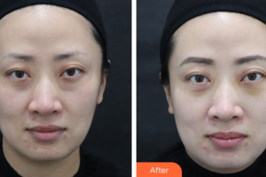 廣州求美醫(yī)學(xué)美容醫(yī)院周邵龍整形價(jià)格表附微創(chuàng)眼袋案例展示