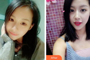 廣州畫美醫(yī)療美容醫(yī)院羅曼整形價(jià)格表附眼部整形案例展示