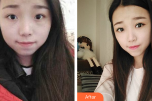 廣州求美醫(yī)學(xué)美容醫(yī)院張春林整形價(jià)格表附眼部手術(shù)案例展示