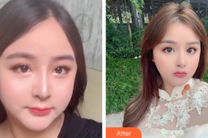 廣州天姿醫(yī)學(xué)美容門診部周祺整形價(jià)格表附面部吸脂案例展示