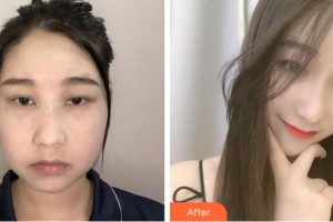 淮北東方美萊塢醫(yī)療美容醫(yī)院方芹整形價(jià)格表附埋線提升案例展示