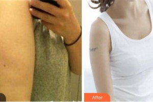 淮北東方美萊塢醫(yī)療美容醫(yī)院高敬鎬整形價(jià)格表附吸脂案例展示