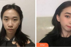 淮北東方美萊塢醫(yī)療美容醫(yī)院崔應(yīng)鈺整形價(jià)格表附微創(chuàng)疤痕修復(fù)案例展示