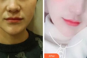 淮北天煌美容整形醫(yī)院吳長淮整形價格表附熱瑪吉案例展示