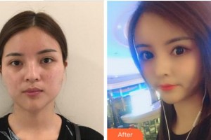 淮北天煌美容整形醫(yī)院張先俠整形價格表附埋線提升案例展示