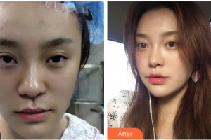 淮北奧斯曼醫(yī)療美容醫(yī)院咸俊宅整形價格表附埋線提升案例展示