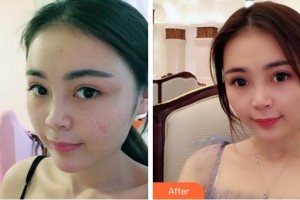 淮北時光整形美容醫(yī)院王峰整形價格表附激光祛疤案例展示