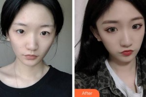淮北市中醫(yī)院整形美容?？贫艜該P整形價格表附切開雙眼皮案例展示