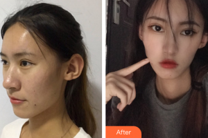 廣州美瑞兒醫(yī)療美容門診部樸壽根整形價(jià)格表附顴骨顴弓案例展示