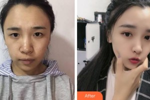 淮北東方美萊塢醫(yī)療美容醫(yī)院康永為整形價格表附眼部綜合案例展示