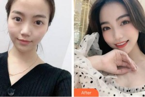 淮北美傾城醫(yī)療美容門診部江嵐整形價格表附眼部整形案例展示