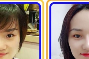 淮北美傾城醫(yī)療美容門診部李尚宇整形價格表附眼部整形案例展示