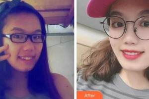 淮北博愛口腔醫(yī)院雷明光整形價格表附口腔矯正案例展示