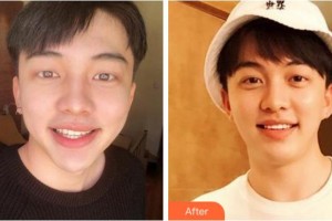 淮北博愛口腔醫(yī)院劉義整形價格表附美白貼片案例展示