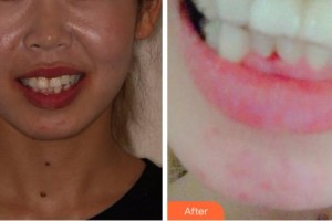 淮北愛美爾醫(yī)療美容門診部趙克儉整形價格表附牙齒隱形矯正案例展示