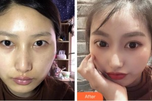 淮北愛爾眼科醫(yī)院高蓉整形價格表附眼部案例展示