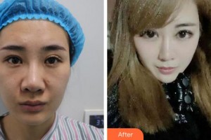 淮北愛爾眼科醫(yī)院張猛整形價格表附眼部綜合案例展示