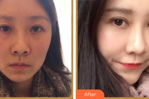 淮北愛爾眼科醫(yī)院魏林整形價格表附眼部綜合案例展示