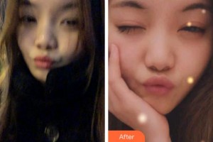 淮北口腔醫(yī)院王昊整形價格表附牙齒隱形矯正案例展示