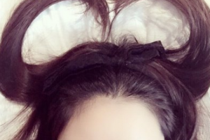 長沙宏朗眼科醫(yī)院楊波整形價(jià)格表附切開雙眼皮案例展示