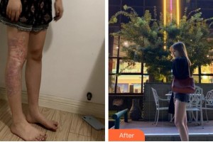 銅陵黃雷醫(yī)療美容診所黃雷整形價格表附微創(chuàng)疤痕修復案例展示