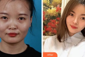 銅陵黃雷醫(yī)療美容診所劉育風整形價格表附下頜角整形案例展示