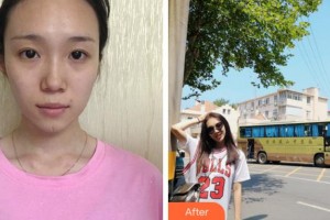 銅陵市人民醫(yī)院燒傷整形科錢尼文整形價格表附激光祛疤案例展示