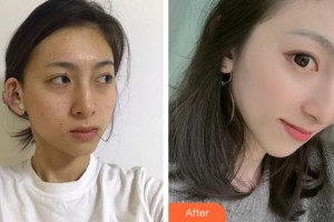 銅陵市人民醫(yī)院燒傷整形科柴勇整形價格表附微創(chuàng)疤痕修復案例展示