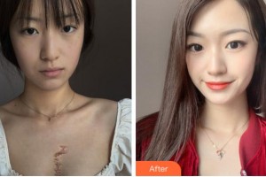 銅陵博愛醫(yī)院整形美容中心苗譯然整形價格表附微創(chuàng)疤痕修復案例展示