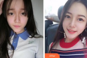 銅陵市立醫(yī)院眼科胡入虎整形價(jià)格表附切開雙眼皮案例展示