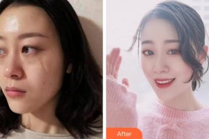 安慶維多利亞醫(yī)療美容門診部喬瑞整形價(jià)格表附激光祛疤案例展示