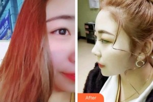 安慶渡江口腔醫(yī)院朱根蘭整形價(jià)格表附超聲波潔牙案例展示