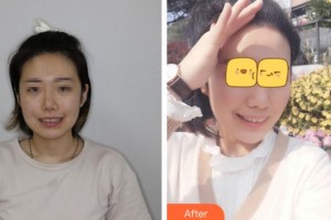 安慶渡江口腔醫(yī)院李永太整形價(jià)格表附牙齒矯正案例展示