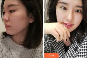 安慶施漢彬愛爾眼科醫(yī)院施漢彬整形價(jià)格表附眼部綜合案例展示