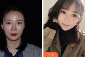 安慶施漢彬愛爾眼科醫(yī)院鄒召中整形價(jià)格表附眼部綜合案例展示