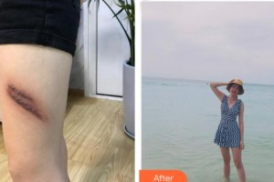 黃山市人民醫(yī)院整形科余發(fā)強(qiáng)整形價(jià)格表附祛疤案例展示