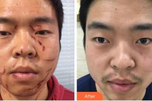 黃山市人民醫(yī)院整形科邊貝奇整形價(jià)格表附微創(chuàng)疤痕修復(fù)案例展示