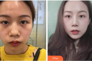 黃山藝美人整形醫(yī)院封晴平整形價(jià)格表附鼻部綜合案例展示