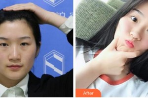 黃山市第三人民醫(yī)院眼科李盈龍整形價格表附雙眼皮案例展示