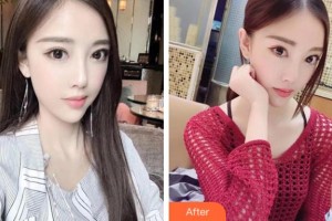 滁州市中西醫(yī)結(jié)合醫(yī)院眼科趙波整形價格表附眼部綜合案例展示