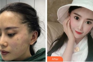 阜陽東方美萊塢醫(yī)療美容醫(yī)院張小瑞整形價格表附熱瑪吉案例展示