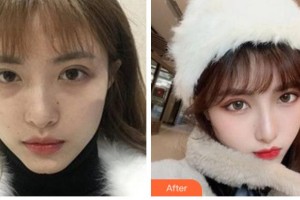 阜陽市人民醫(yī)院整形美容外科盛華整形價格表附熱瑪吉案例展示