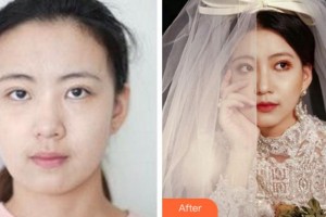 阜陽市人民醫(yī)院整形美容外科馬杰整形價格表附熱瑪吉案例展示