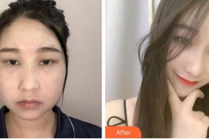 阜陽市人民醫(yī)院整形美容外科方建強住院醫(yī)師整形價格表附埋線提升案例展示