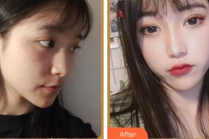 阜陽市人民醫(yī)院整形美容外科裴麗麗整形價格表附埋線提升案例展示