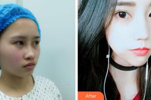 阜陽皮膚病醫(yī)院醫(yī)療美容科王世明整形價格表附埋線提升案例展示